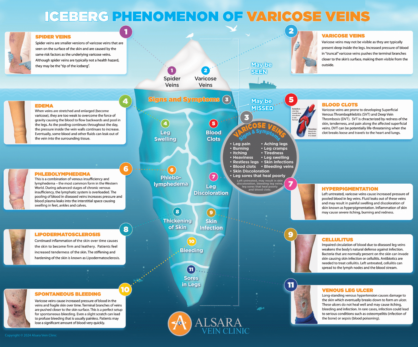 Iceberg Phenomenon of Varicose Veins